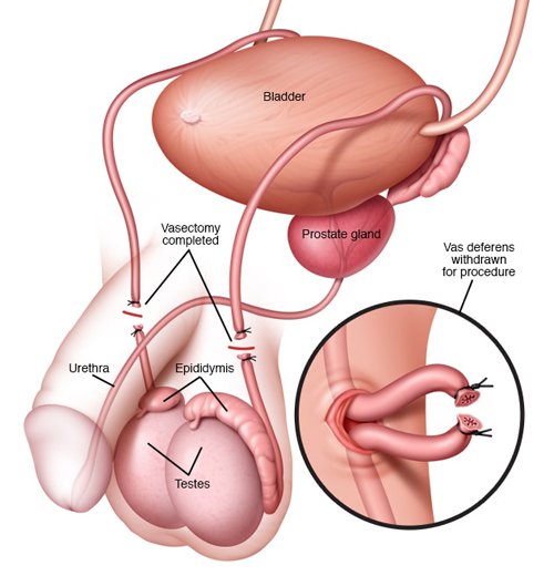 Vasectomy – Desert Mountain Urology