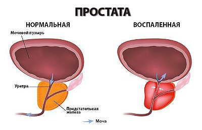 уролог Киев недорого, лечение острого простатита, простатит лечение недорого, острый простатит врач, урологическая клиника острый простатит