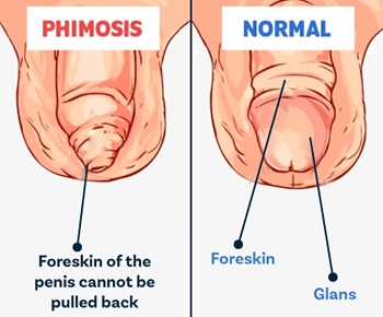 what is phimosis