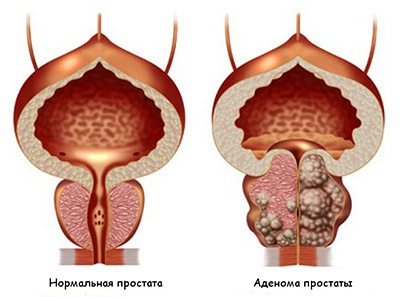 Аденома предстательной железы лечение